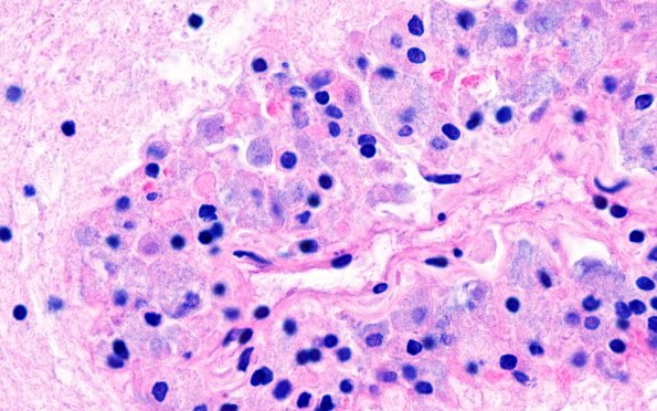 3A4 Mycobacterium, atypical MAI (AANP1995, Case 6) H&E 6