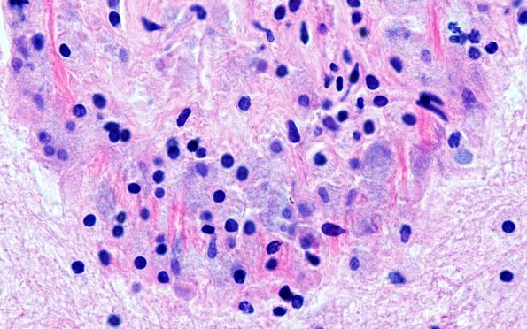 3A5 Mycobacterium, atypical MAI (AANP1995, Case 6) H&E 2