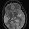 1A1 Mycoplasma Leukoencephalitis (Case 1) 12-19 TIRM Blade no contrast - Copy