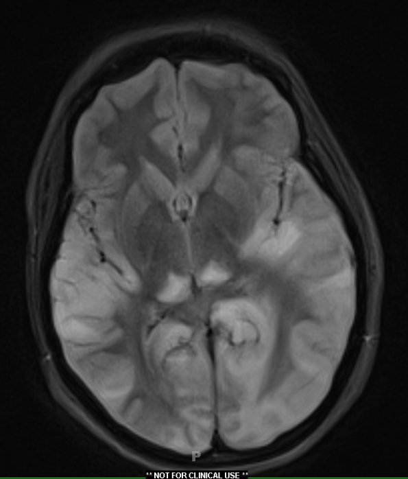 1A1 Mycoplasma Leukoencephalitis (Case 1) 12-19 TIRM Blade no contrast - Copy