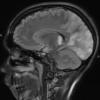 1A2 Mycoplasma Leukoencephalitis (Case 1) 12-19 TIRM 2 - Copy