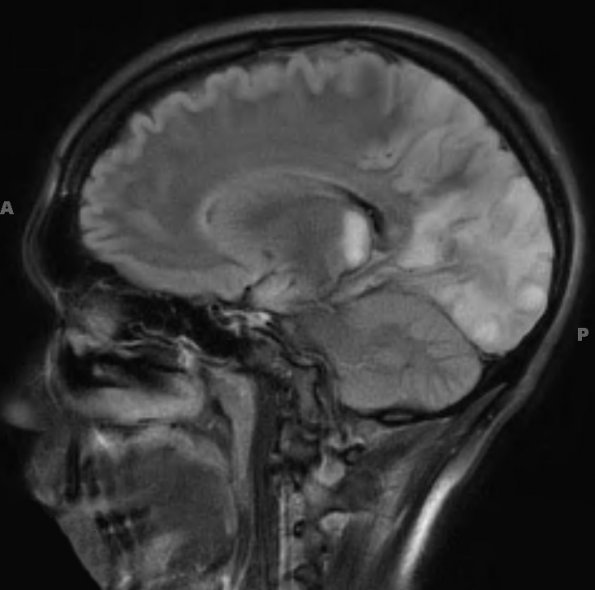 1A2 Mycoplasma Leukoencephalitis (Case 1) 12-19 TIRM 2 - Copy