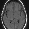 1A3 Mycoplasma Leukoencephalitis (Case 1) T1 BLADE W - Copy copy