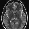 1A4 Mycoplasma Leukoencephalitis (Case 1) 12-14 T2 Blade with contrast 4 (5 days earlier) - Copy