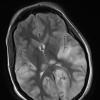 1A5 Mycoplasma Leukoencephalitis (Case 1) 12-19 T2 Blade with contrast 3 - Copy