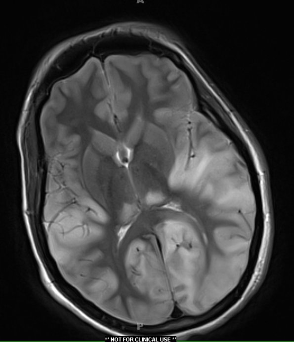 1A5 Mycoplasma Leukoencephalitis (Case 1) 12-19 T2 Blade with contrast 3 - Copy