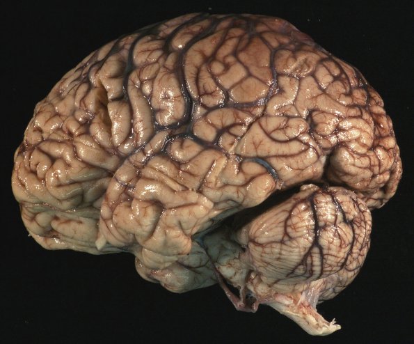 1B1 Mycoplasma Leukoencephalitis (Case 1)_1