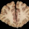 1B2 Mycoplasma Leukoencephalitis (Case 1)_3