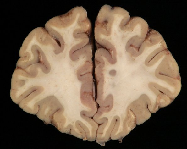 1B2 Mycoplasma Leukoencephalitis (Case 1)_3