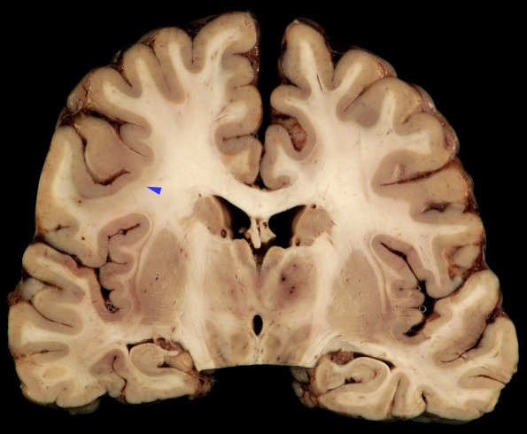 1B3 Mycoplasma Leukoencephalitis (Case 1)_6 copy