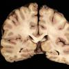 1B4 Mycoplasma Leukoencephalitis (Case 1)_7