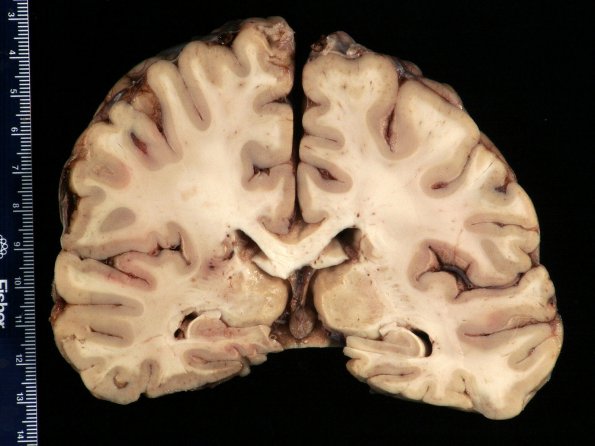 1B4 Mycoplasma Leukoencephalitis (Case 1)_7