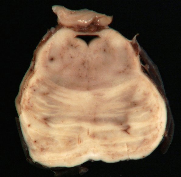 1B5 Mycoplasma Leukoencephalitis (Case 1)_11