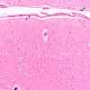 1C1 Mycoplasma Leukoencephalitis (Case 1) N1 H&E 4 copy