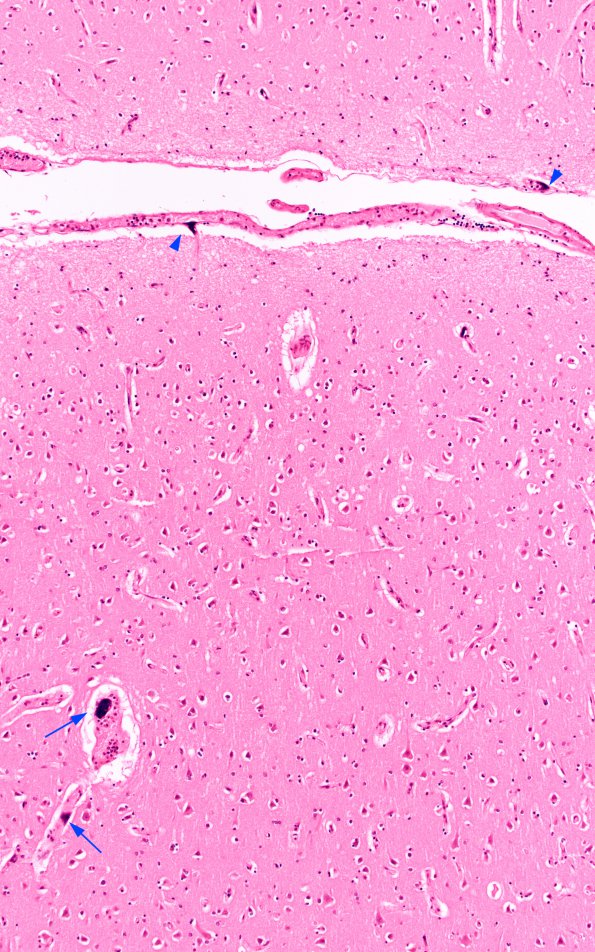 1C1 Mycoplasma Leukoencephalitis (Case 1) N1 H&E 4 copy