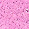 1C10 Mycoplasma Leukoencephalitis (Case 1) N5 H&E 4