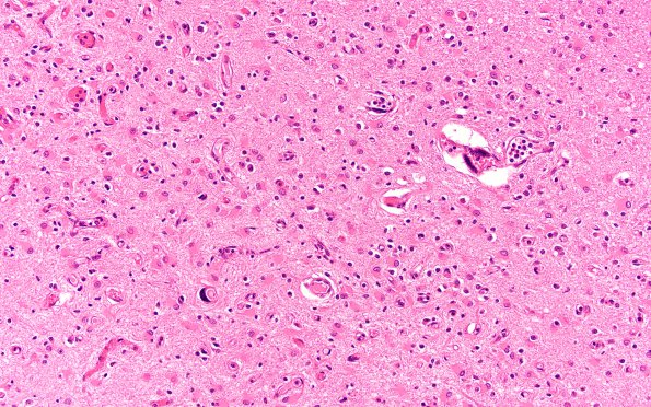 1C10 Mycoplasma Leukoencephalitis (Case 1) N5 H&E 4