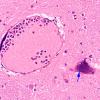 1C11 Mycoplasma Leukoencephalitis (Case 1) N4 H&E 6 copy