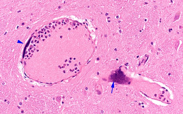 1C11 Mycoplasma Leukoencephalitis (Case 1) N4 H&E 6 copy