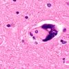 1C12 Mycoplasma Leukoencephalitis (Case 1) N4) H&E 100X 1