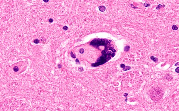 1C12 Mycoplasma Leukoencephalitis (Case 1) N4) H&E 100X 1