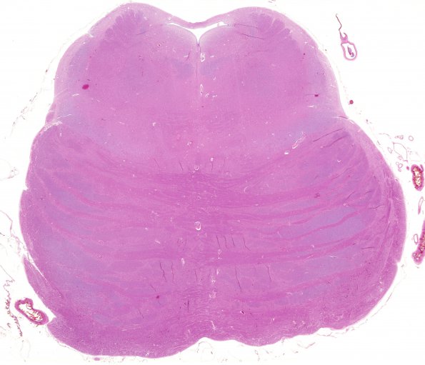 1C13 Mycoplasma Leukoencephalitis (Case 1) H&E whole mount pons