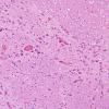 1C14 Mycoplasma Leukoencephalitis (Case 1) N7 H&E 9