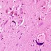 1C15 Mycoplasma Leukoencephalitis (Case 1) N7 H&E 11