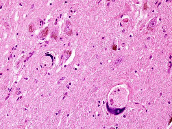 1C15 Mycoplasma Leukoencephalitis (Case 1) N7 H&E 11