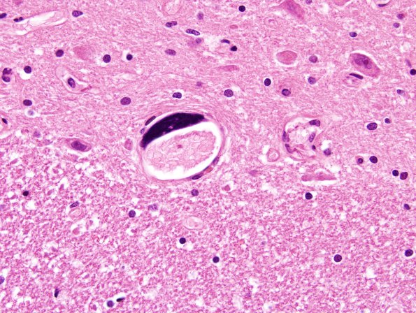 1C16 Mycoplasma Leukoencephalitis (Case 1) N7 H&E 5