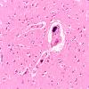 1C2 Mycoplasma Leukoencephalitis (Case 1) N1 H&E 3