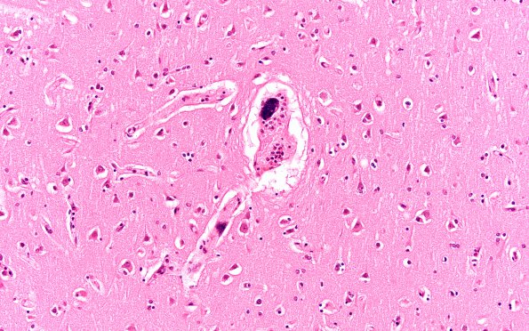 1C2 Mycoplasma Leukoencephalitis (Case 1) N1 H&E 3