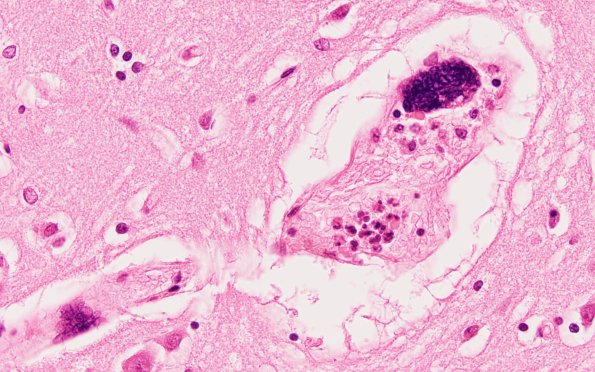 1C3 Mycoplasma Leukoencephalitis (Case 1) N1 H&E 1