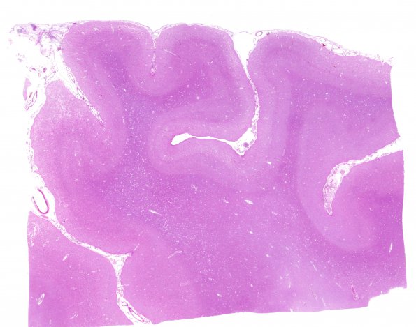 1C4 Mycoplasma Leukoencephalitis (Case 1) N5 H&E whole mount occipital