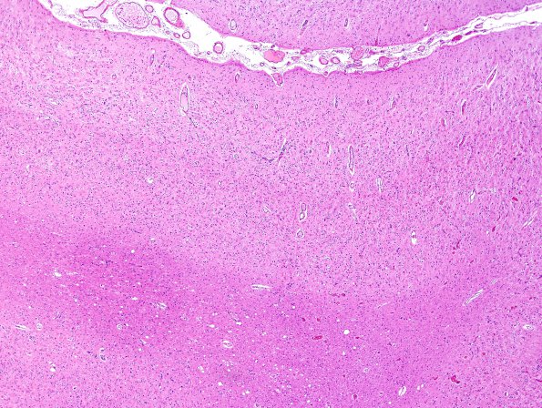 1C5 Mycoplasma Leukoencephalitis (Case 1) N5 H&E 2