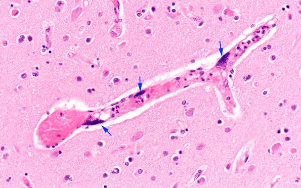 1C6 Mycoplasma Leukoencephalitis (Case 1) N5 H&E 3 copy