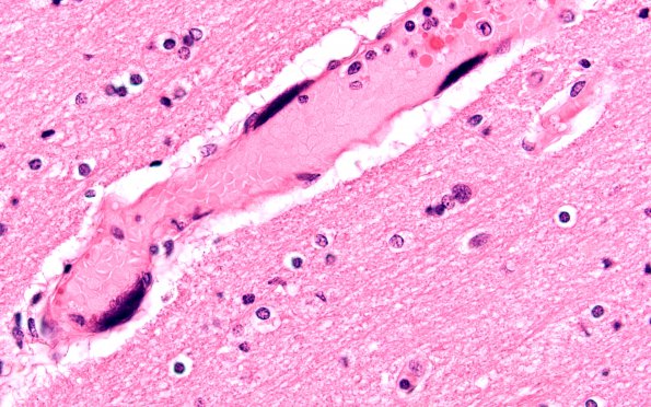 1C7 Mycoplasma Leukoencephalitis (Case 1) N5 H&E 7