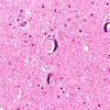 1C8 Mycoplasma Leukoencephalitis (Case 1) N5 H&E 2