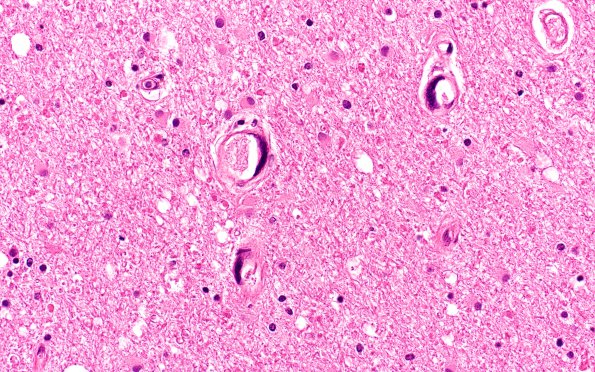 1C8 Mycoplasma Leukoencephalitis (Case 1) N5 H&E 2