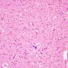 1C9 Mycoplasma Leukoencephalitis (Case 1) N14 H&E 1 copy