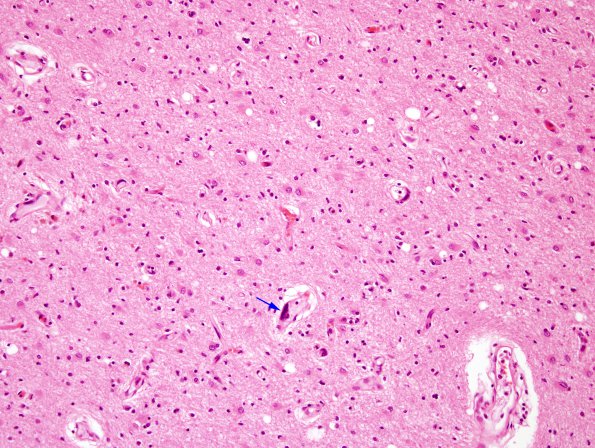 1C9 Mycoplasma Leukoencephalitis (Case 1) N14 H&E 1 copy