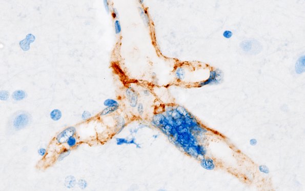 1D1 Mycoplasma Leukoencephalitis (Case 1) N1 CD34 9