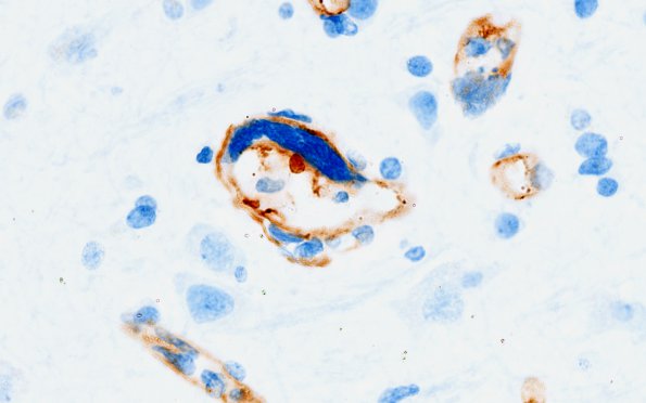 1D2 Mycoplasma Leukoencephalitis (Case 1) N1 CD34 5