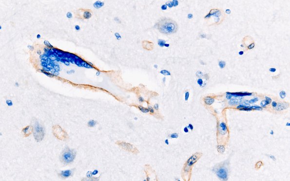 1E1 Mycoplasma Leukoencephalitis (Case 1) N1 Coll IV 1