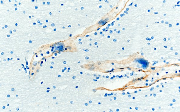 1E2 Mycoplasma Leukoencephalitis (Case 1) N1 Coll IV 2