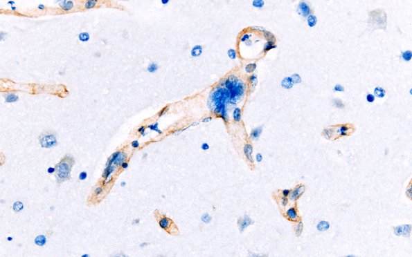1E3 Mycoplasma Leukoencephalitis (Case 1) N1 Coll IV 3