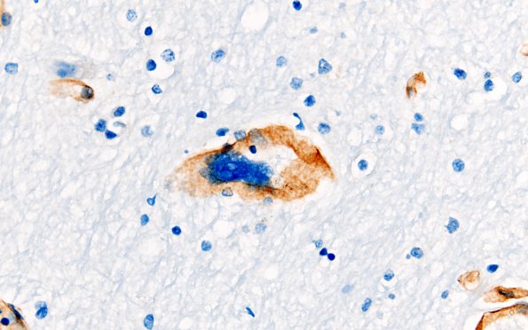 1E4 Mycoplasma Leukoencephalitis (Case 1) N4 Coll IV 15