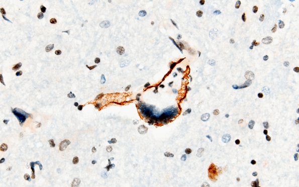 1F1 Mycoplasma Leukoencephalitis (Case 1) N4 SMA 1