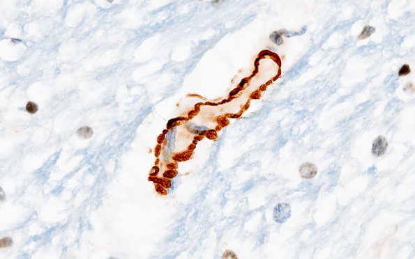 1F2 Mycoplasma Leukoencephalitis (Case 1) N4 SMA 3