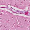 1G Mycoplasma Leukoencephalitis (Case 1) N1 Trichrome